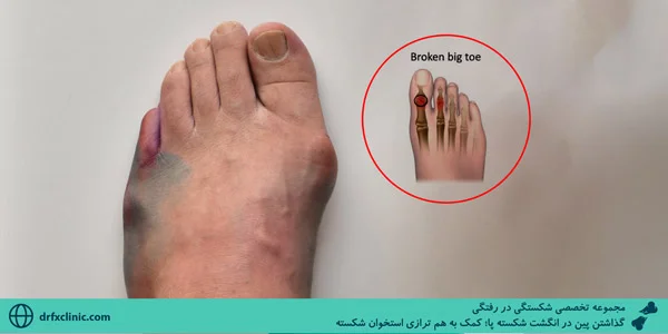 putting-a-pin-in-a-broken-toe-Helping-to-align-broken-bones