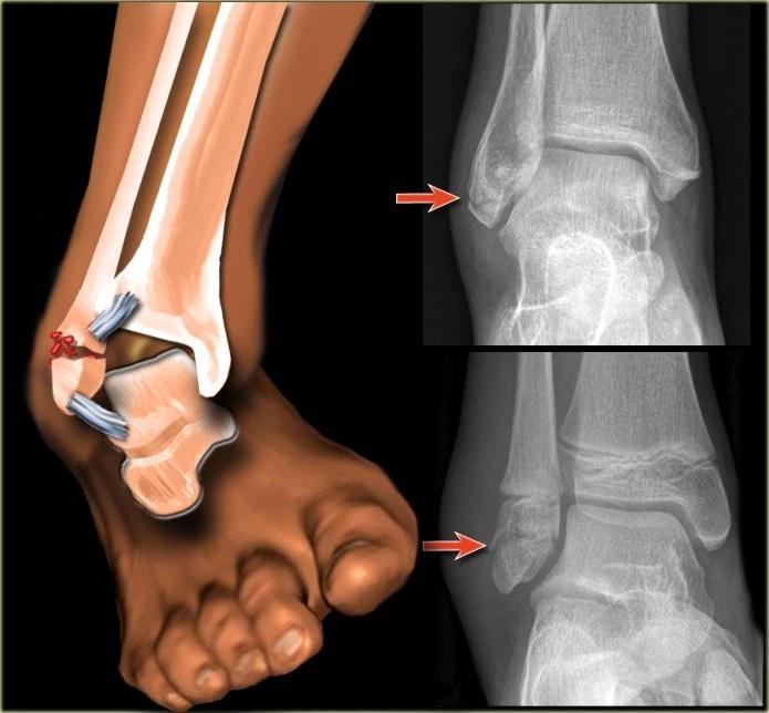 Ankle-fracture-home-treatment