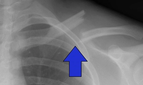 Clavicle-fracture