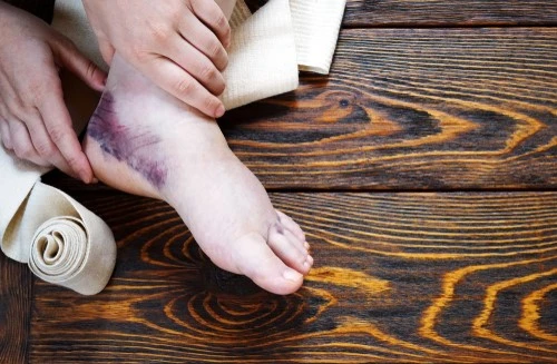Symptoms-ankle-sprain