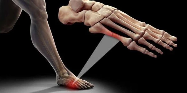 Symptoms-bone-fracture-leg