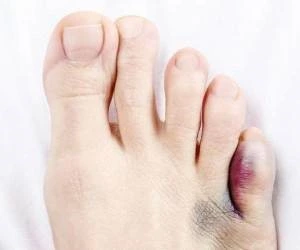 Toe-fracture-treatment