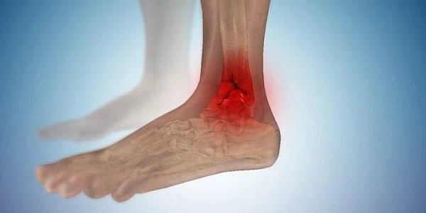 Treatment-ankle-bone-fracture
