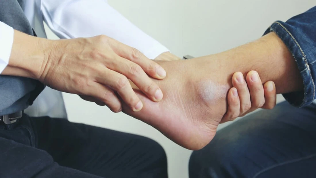 Treatment-ankle-swelling-after-fracture